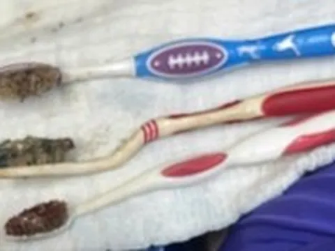 Nuốt 3 bàn chải đánh răng, nam bệnh nhân được cứu bằng nội soi