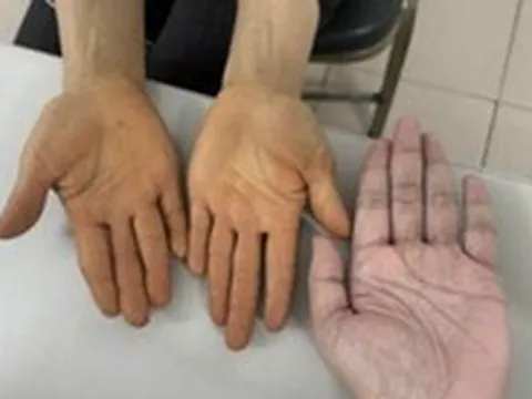 Không mắc bệnh về gan, tại sao lòng bàn tay, bàn chân chuyển màu vàng?