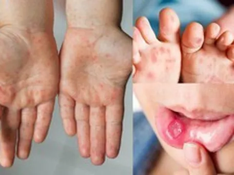 Cảnh báo bệnh tay chân miệng và sốt xuất huyết tiếp tục gia tăng, nhiều ca nặng