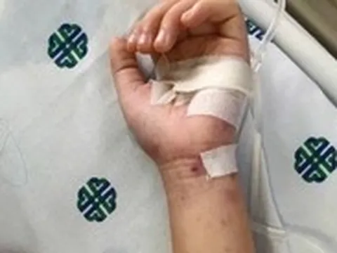 TP.HCM: Bé hơn 2 tuổi tử vong do viêm màng não mô cầu thể tối cấp, diễn tiến rất nhanh