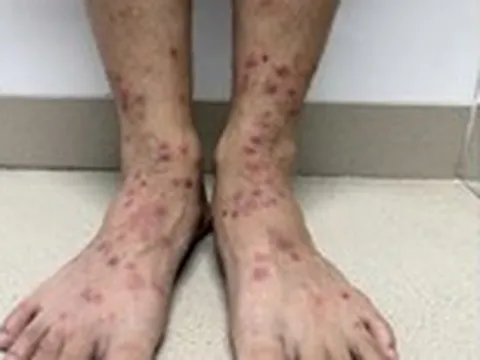 Bọ chét chó, mèo ‘tấn công’ người, gây ngứa ngáy, viêm da vì điều trị sai cách