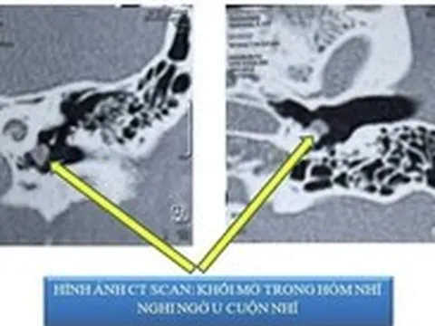 Bệnh nhân bị ù tai đến khám, bác sĩ bất ngờ phát hiện bệnh lạ