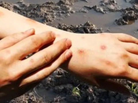 Cảnh giác 'sốt đất' - căn bệnh xuất hiện từ bùn đất
