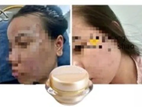Phát hiện công ty ở TP.HCM sản xuất mỹ phẩm chứa chất cấm Dexamethason, tiêu hủy 107 lô