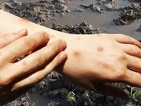 Bệnh ‘sốt đất’ làm 23 người chết tại Thái Lan: Bộ Y tế cảnh báo, đưa ra các biện pháp phòng ngừa