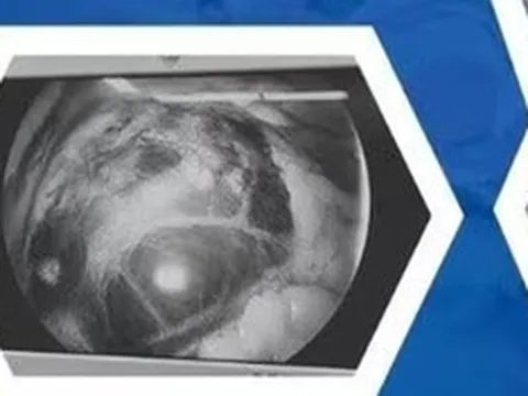 Chỉ đau bụng nhẹ nên chủ quan, người phụ nữ "chết lặng" khi phát hiện thai lạc chỗ ở vị trí cực kỳ nguy hiểm