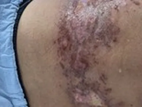 Zona thần kinh có lây không, cách nào phòng tránh?