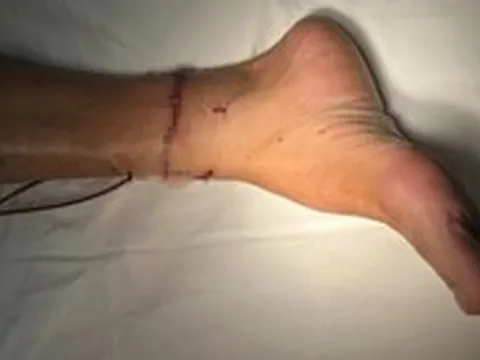 Nối thành công bàn chân đứt lìa sau 3 tiếng rưỡi vụ tai nạn xảy ra