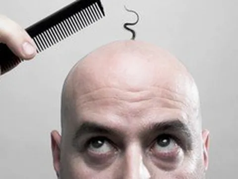 Quốc gia nào có nhiều người hói nhất thế giới?
