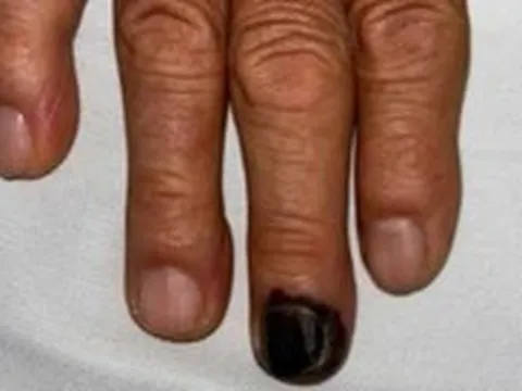 Móng tay màu đen như tụ máu, có thể là dấu hiệu của ung thư