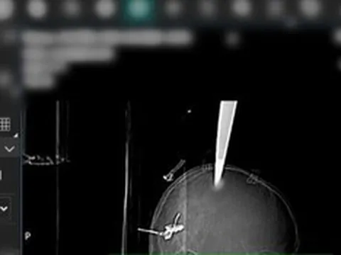 Một phút bất cẩn khi vui chơi, bé 11 tuổi gặp chấn thương nghiêm trọng