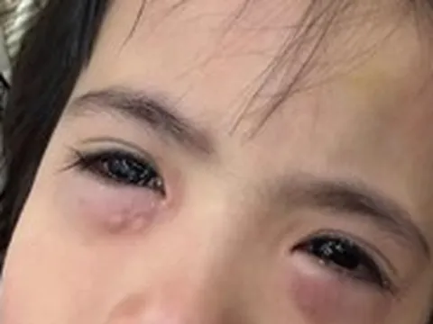 Chơi bong bóng xà phòng, bé gái 5 tuổi nhập viện vì viêm kết mạc