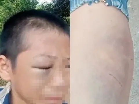 Xôn xao clip bé trai mắt bầm tím, khóc kêu cứu vì nhiều lần bị đánh đập khi ở cùng bố và vợ mới