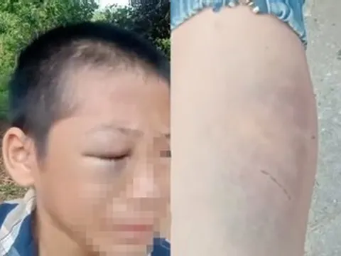 Xác minh clip bé trai mắt bầm tím, khóc kêu cứu vì 'nhiều lần bị đánh đập'
