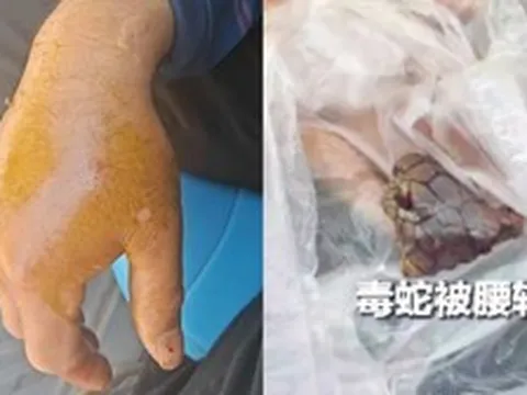 Bị rắn hổ mang chúa dài 2 mét cắn, người đàn ông chém đứt xác rắn rồi đến bệnh viện