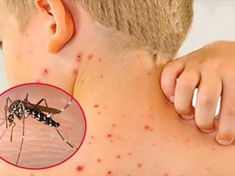 Dịch sốt xuất huyết tăng cao, chuyên gia cảnh báo biến chứng nặng của bệnh
