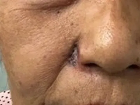 Ca bệnh hy hữu: Từ nốt ruồi nhỏ, ung thư xâm nhập phá hủy cánh mũi