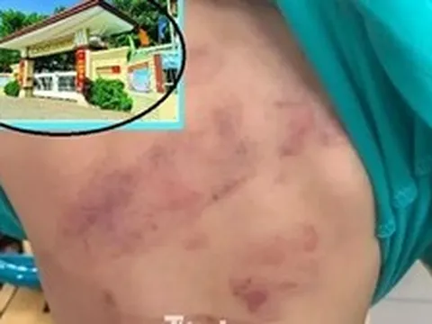 Học sinh lớp 1 bị bạn đánh hội đồng, phụ huynh bức xúc vì con phải chuyển lớp