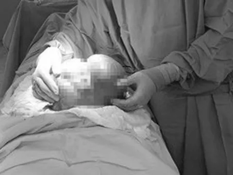 Người phụ nữ 42 tuổi bụng to bất thường, bác sĩ phát hiện thứ "đáng sợ" 3kg bên trong