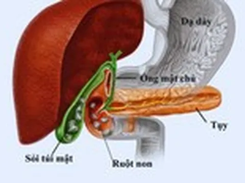 Ăn gì để ngăn ngừa bệnh sỏi mật?