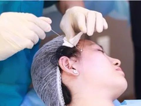 Trào lưu tự căng da mặt tại nhà gây sốc: Nhiều cô gái đối mặt nguy cơ hủy hoại gương mặt