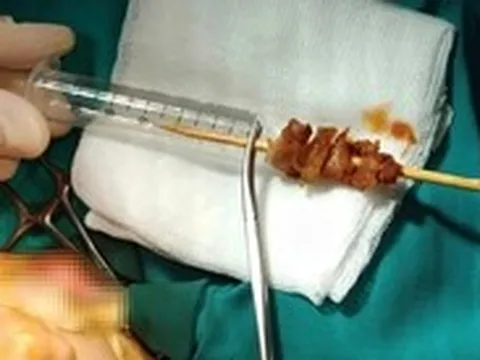 Chạy nhảy, bé gái bị que xiên thịt đâm sâu suýt xuyên sọ não