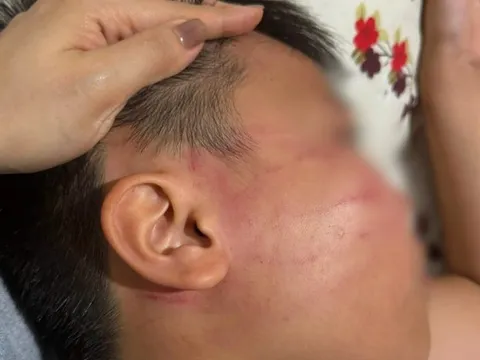Vụ nam sinh lớp 4 bị giáo viên đánh bầm mặt: Bất ngờ phát hiện lớp dạy thêm tiếng Anh “chui”