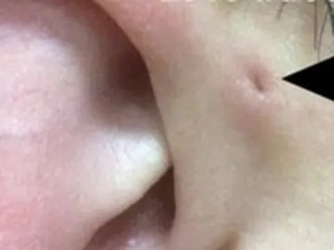 Gia đình 3 thế hệ cùng mắc bệnh ít gặp rò luân nhĩ: Bệnh có nguy hiểm không?