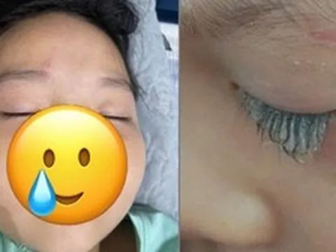Chỉ 1 phút lơ là mà con gái suýt mù mắt, mẹ bỉm chia sẻ bài học “xương máu” và cách sơ cứu giải nguy trong gang tấc