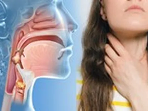 Triệu chứng ung thư vòm họng dễ nhầm với viêm họng, viêm xoang