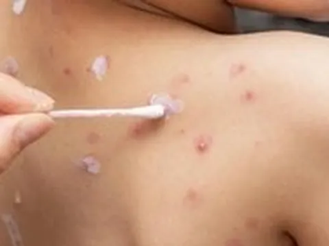 Cần xóa bỏ lầm tưởng ‘thủy đậu là bệnh nhẹ, dễ lành’