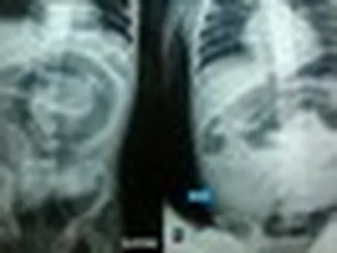 Bé trai đau bụng dữ dội, nôn ói suốt 3 ngày: Bác sĩ mổ khẩn, phát hiện thứ khó tin chặn kín ruột