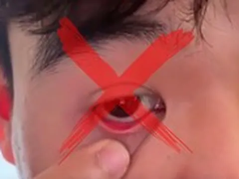 Chiêu trò lôi 'ký sinh trùng' ra từ mắt