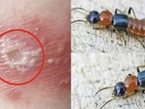 Mùa kiến ba khoang, cẩn trọng nhầm với zona thần kinh