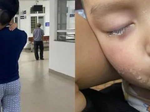 Suýt hối hận cả đời vì vài phút lơ đễnh: Lại thêm 1 em bé bị keo 502 dính vào mắt