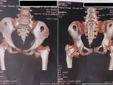 Bé gái 12 tuổi mắc hội chứng người hóa đá cực hiếm