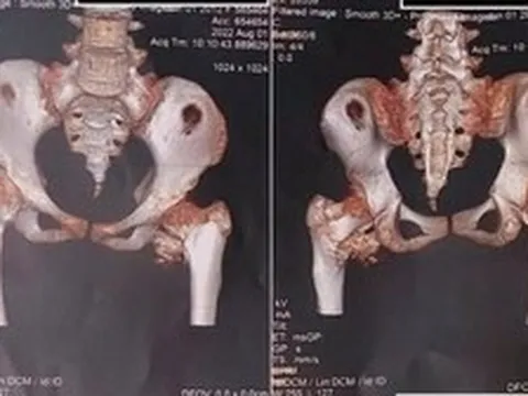 Bé gái 12 tuổi mắc "hội chứng người hóa đá hiếm gặp", bố mẹ ngỡ ngàng khi bác sĩ nhắc tới cú ngã xe đạp 2 năm trước