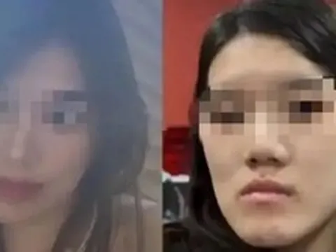 Cô gái bị biến dạng khuôn mặt sau PTTM, bi kịch đau khổ vì quyết định sai lầm