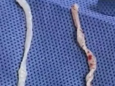 Đau cánh tay suốt một năm, người phụ nữ bàng hoàng khi bác sĩ phát hiện hai sinh vật dài 10cm đang sống dưới da