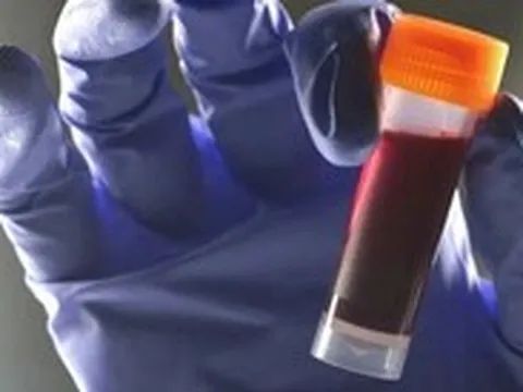 Trong 8 nhóm máu, nhóm nào có nguy cơ tiểu đường type 2 cao hơn?