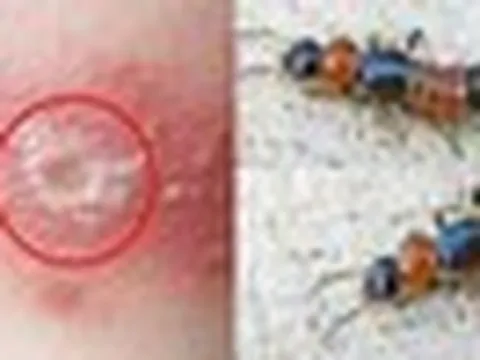 5 bước xử lý đúng cách khi tiếp xúc với kiến 3 khoang