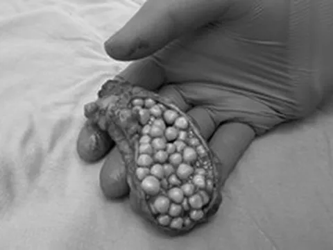 Đau bụng suốt 1 tháng, người phụ nữ 38 tuổi sốc khi bác sĩ lấy ra thứ "đáng sợ" trong bụng