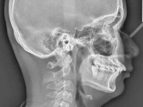 Tiếng ngáy ở trẻ em cảnh báo dấu hiệu không nên bỏ qua