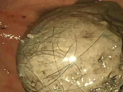 Bé gái 10 tuổi đau bụng suốt 3 năm, bố mẹ sốc khi bác sĩ lấy ra thứ "đáng sợ" trong bụng