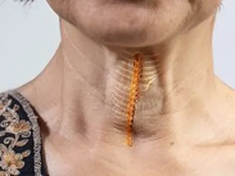 Vì sao mắc xương cá có thể đe dọa đến tính mạng?