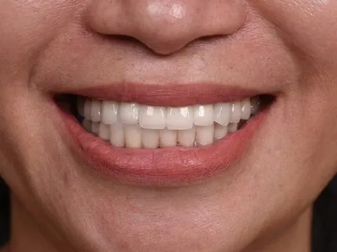 Những trường hợp nào không nên làm răng sứ?