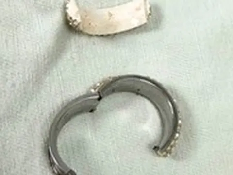 Cấp cứu nam thanh niên bị thắt nghẹt dương vật do đeo 'cock ring'