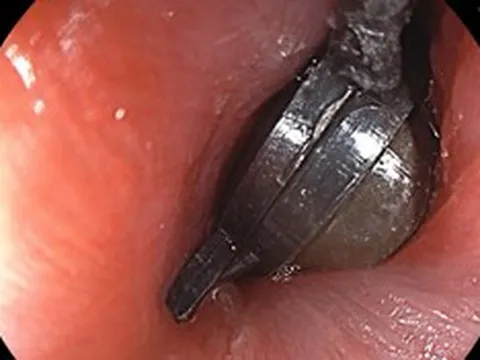 Bé 5 tuổi đau bụng dữ dội, bố mẹ sốc khi bác sĩ gắp ra thứ "đáng sợ" bên trong