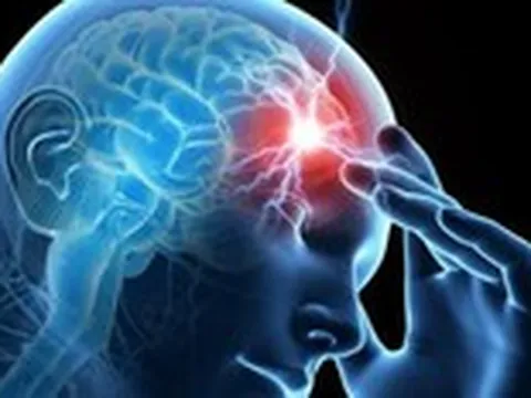 Chóng mặt, buồn nôn: Dấu hiệu đột quỵ tiểu não dễ nhầm với rối loạn tiền đình