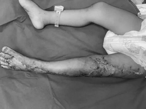 Bị rắn hổ mang cắn nguy kịch, bé 41 tháng tuổi được cứu sống ngoạn mục
